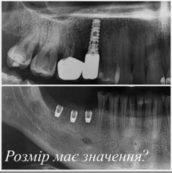 x-ray picture  with implants